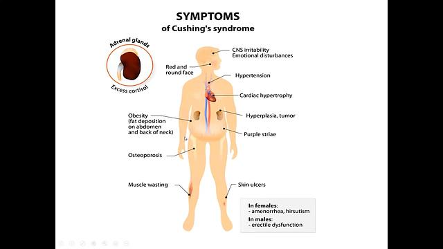 Corticosteroids 2-Cushing's syndrome treatment