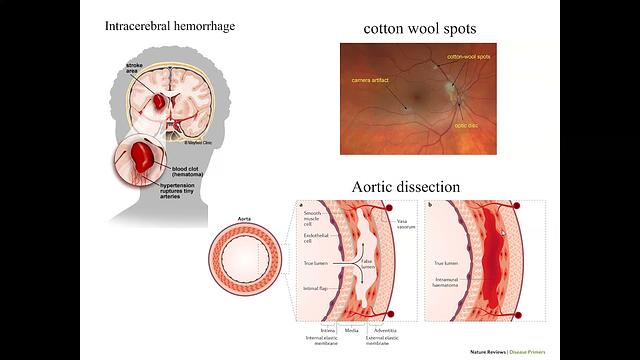 HTN13-Hypertensive Emergencies